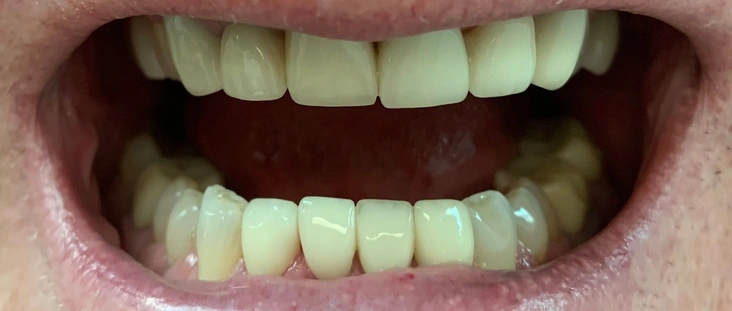 After - Smile transformation case 4