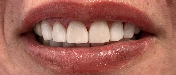 After - Smile transformation case 6