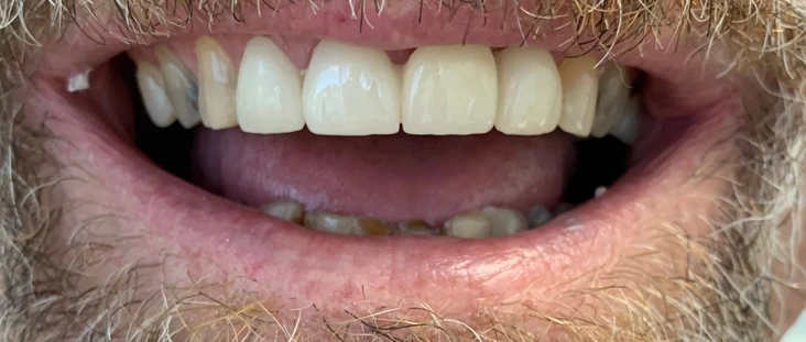 After - Smile transformation case 7