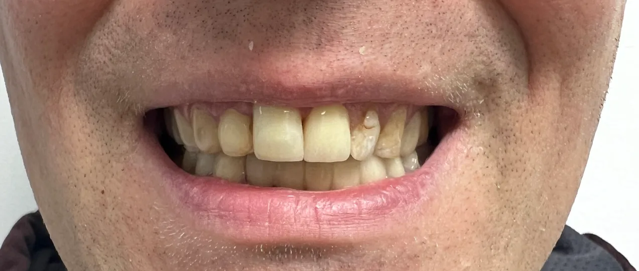 After - Smile transformation case 1