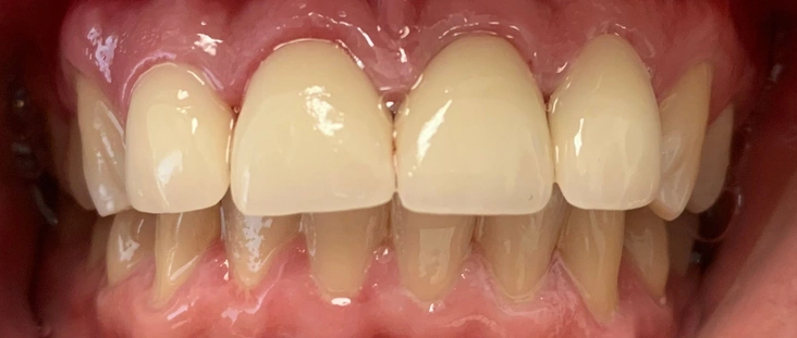 After - Smile transformation case 10