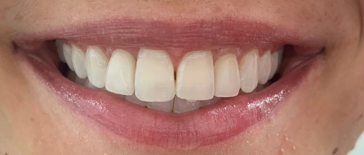 After - Smile transformation case 11