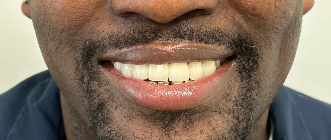After - Smile transformation case 2