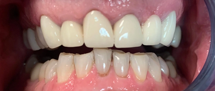 Before - Smile transformation case 4