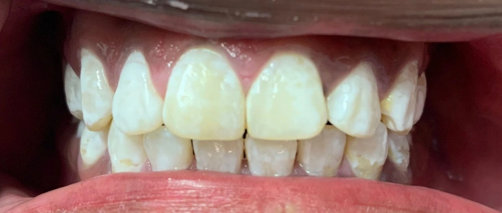 Before - Smile transformation case 5