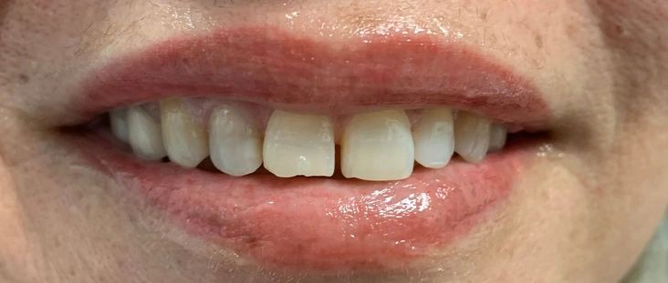 Before - Smile transformation case 6