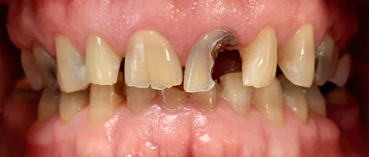 Before - Smile transformation case 7