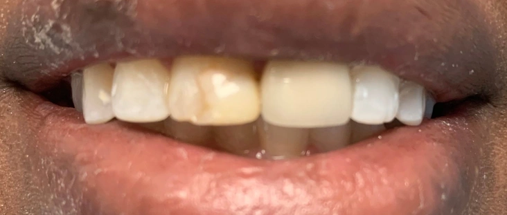Before - Smile transformation case 8