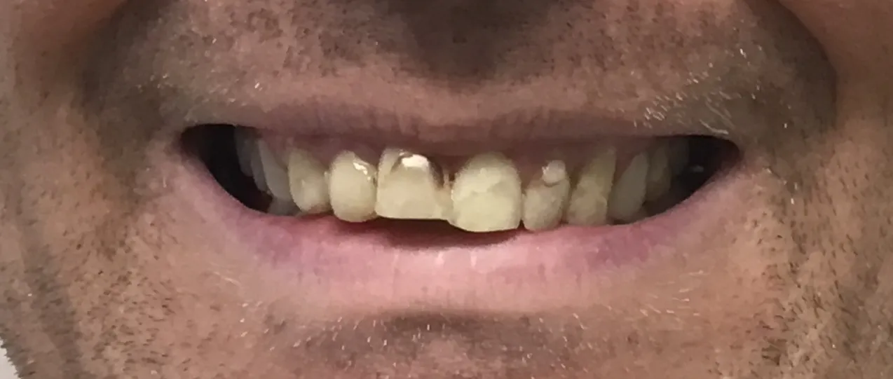 Before - Smile transformation case 1