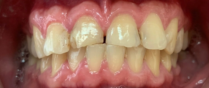 Before - Smile transformation case 10