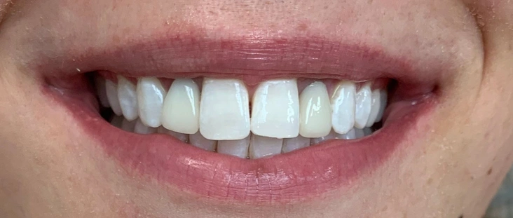 Before - Smile transformation case 11